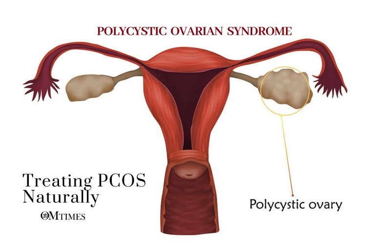 POLYCYSTIC OVARIAN SYNDROME