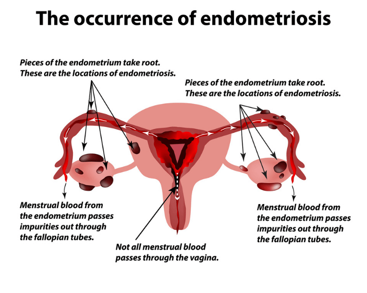 Endometriosis